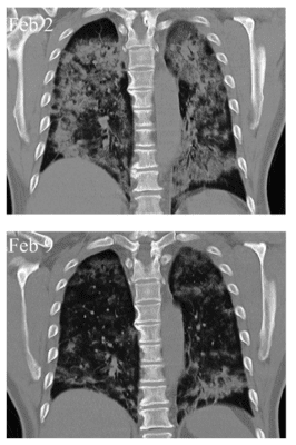 MSCs & COVID-19 | Lung Function