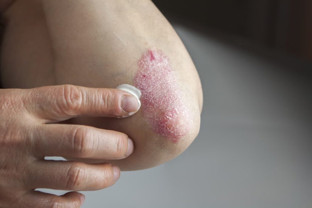 Novel Therapeutic Approaches to Psoriasis