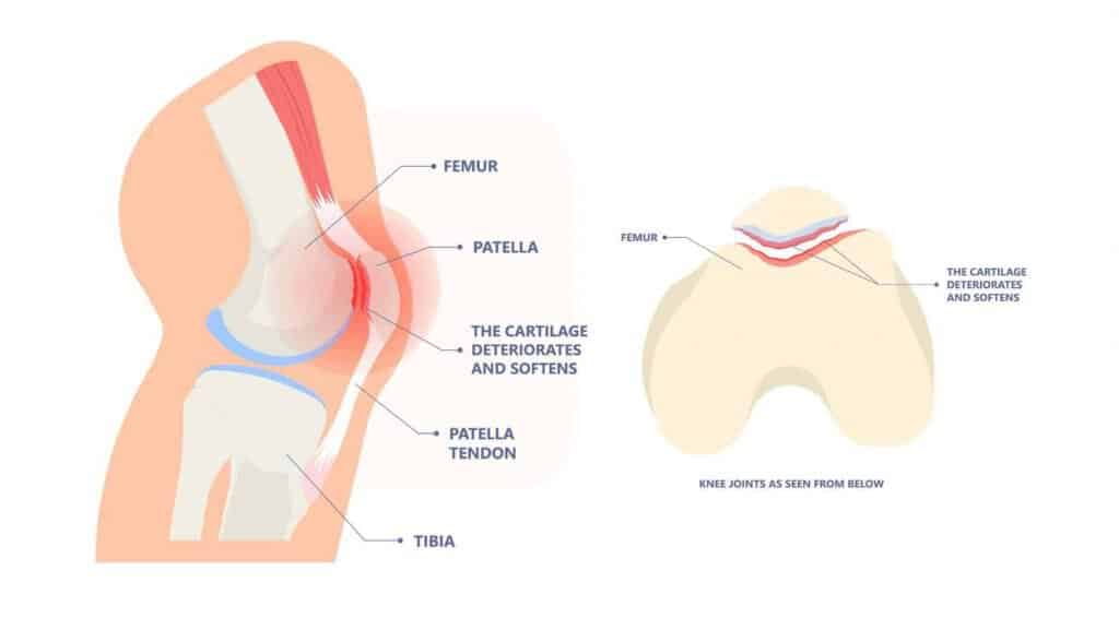 Patellofemoral