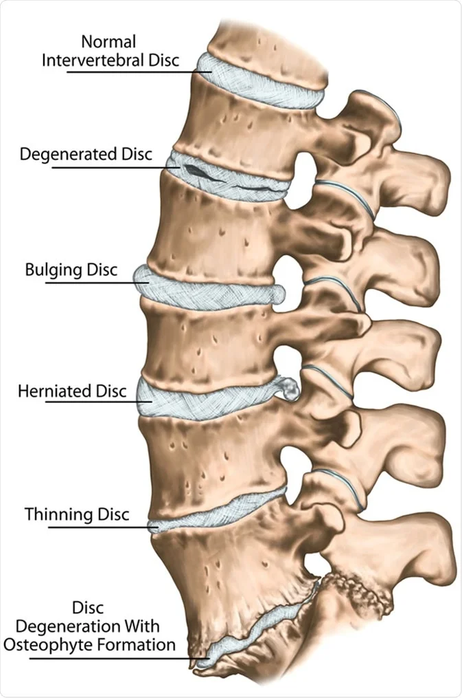 Is Degenerative Disc Disease Hereditary