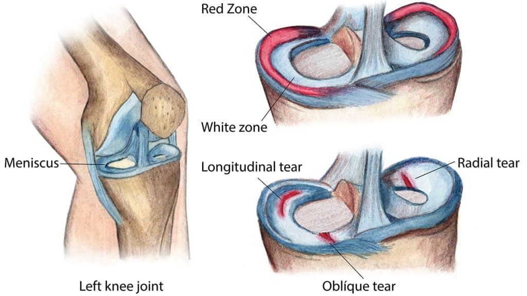 Meniscus Tears