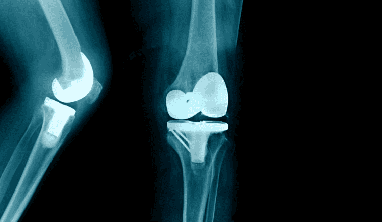 Can You Run After Knee Replacement?