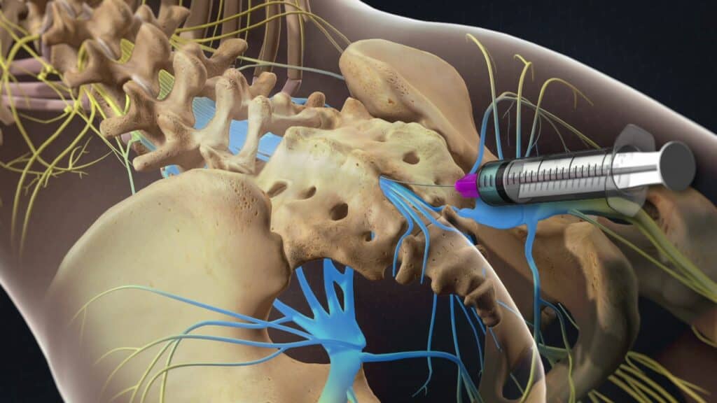 signs of nerve damage from epidural